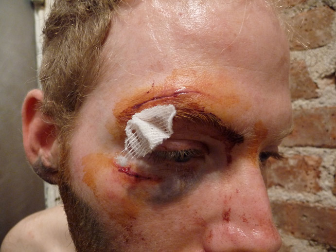 Molly and I did this after a bike crash